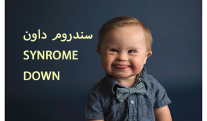 down syndrome