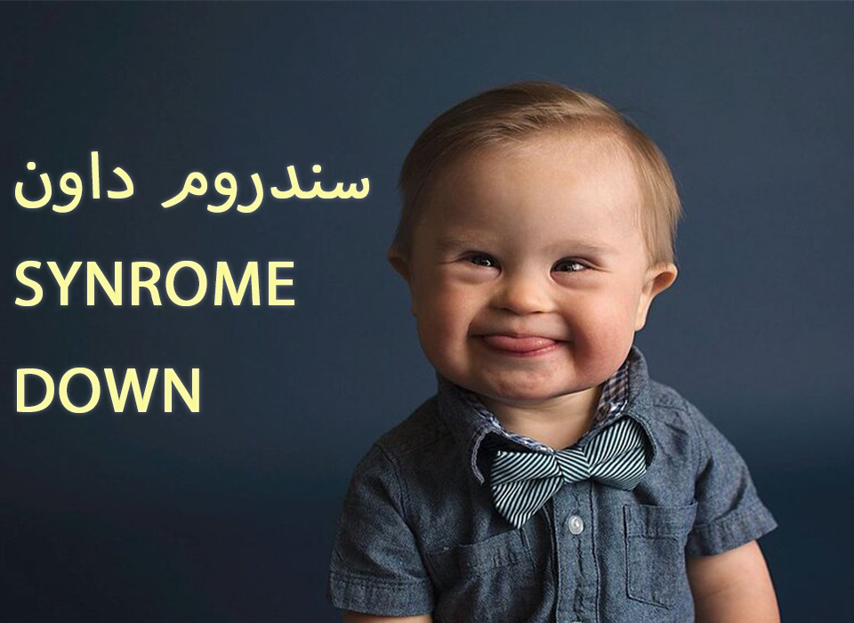 down syndrome