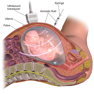 amniocentesis