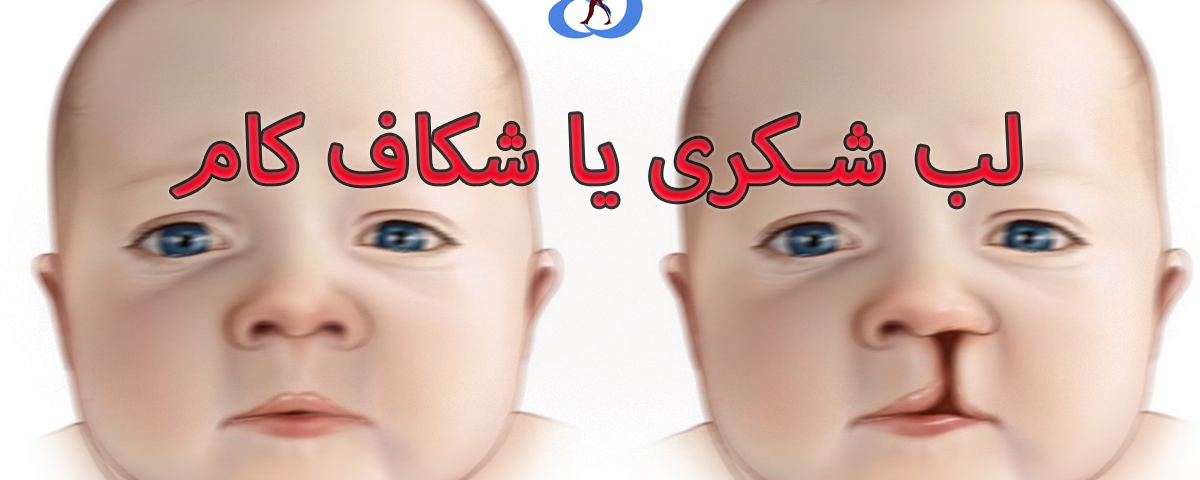 Cleft palate disease