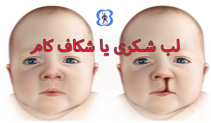 Cleft palate disease