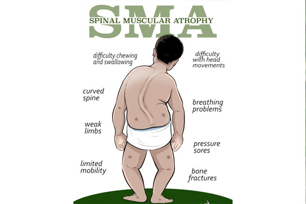 درمان بیماری آتروفی عضلانی نخاعی
